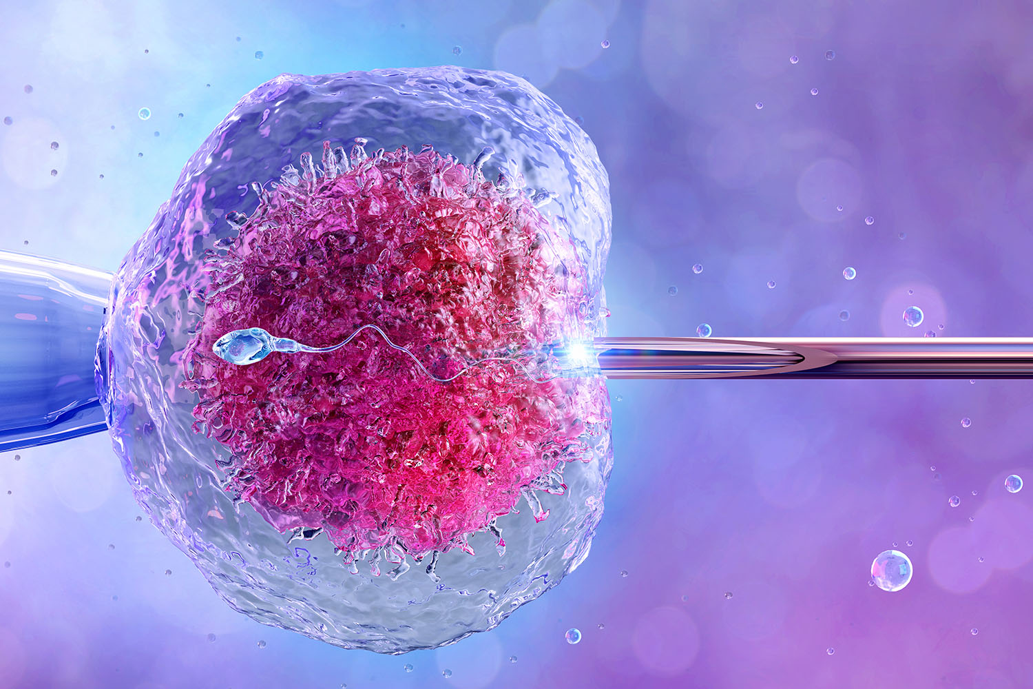 IVF – In-Vitro Fertilization procedure at IV HOS